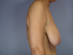 Los Angeles Laser Bra Before and After Photos - Marina Del Rey